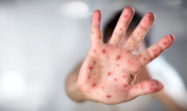Saúde alerta para surto de sarampo em SP, disponibiliza vacina e pede que escolas de Bariri orientem atualização da caderneta de vacinação dos alunos