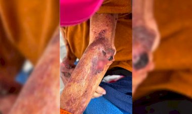 Idosa é achada ferida e desnutrida em Arealva; filha é presa por maus-tratos